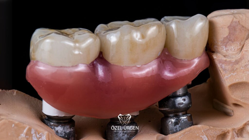İmplant Üstü Protez Nedir?