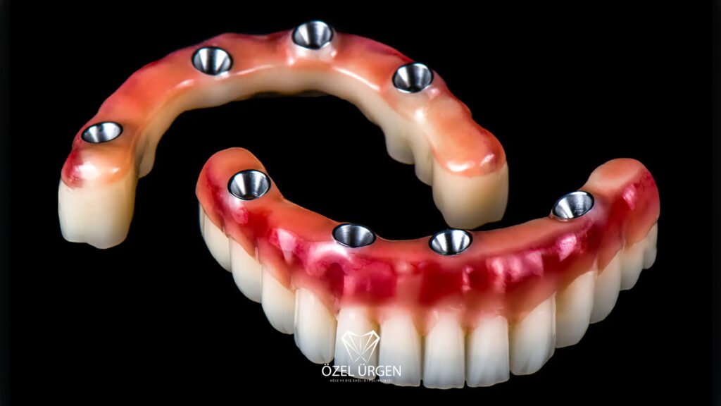 İmplant Üstü Protez Nedir?