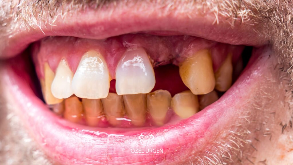 The Effects of Smoking on Teeth