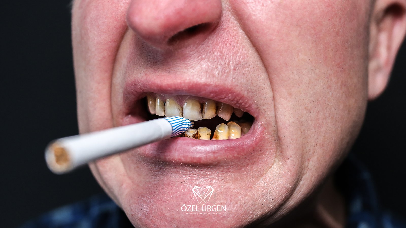 Sigaranın Dişe Verdiği Zararlar