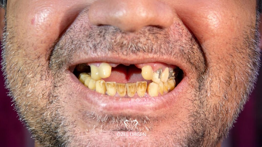 The Effects of Smoking on Teeth