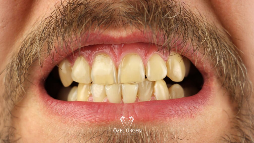 The Effects of Smoking on Teeth