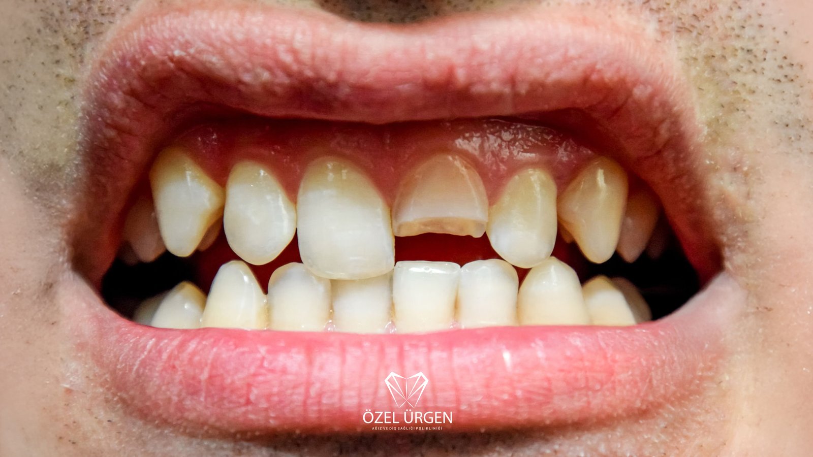 Kırık Diş Tedavisi