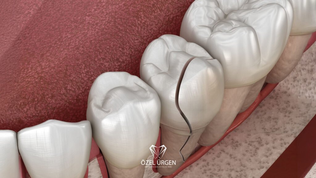 Broken Tooth Treatment