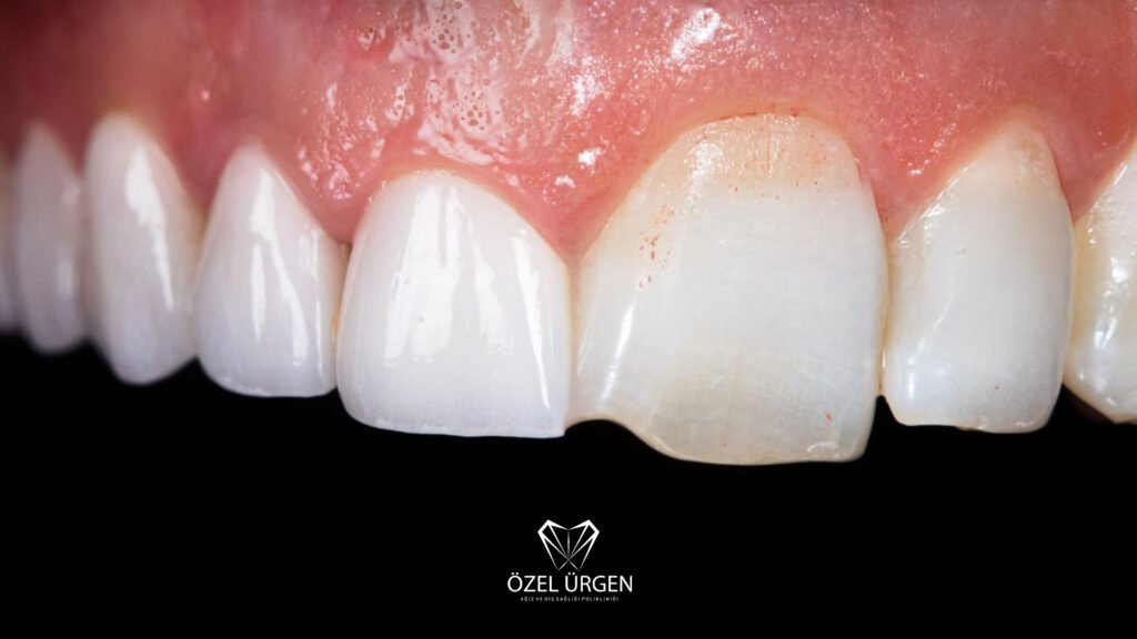 Broken Tooth Treatment