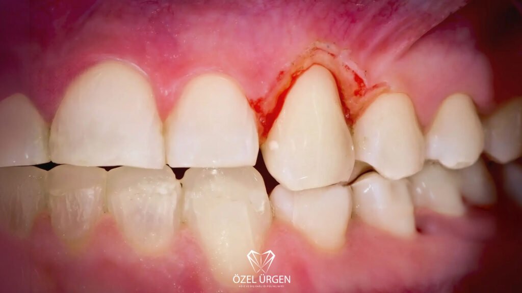 Gum Inflammation