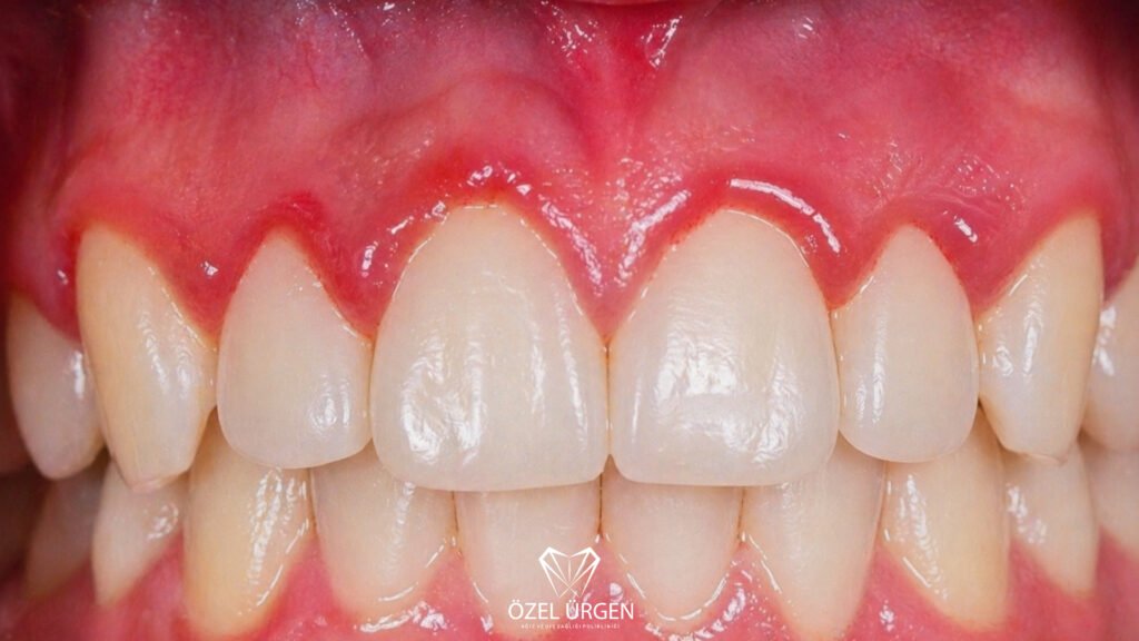 Gum Inflammation