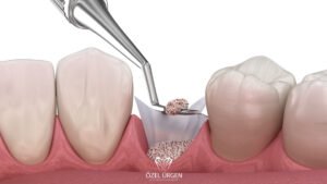 Kemik Grefti Nedir