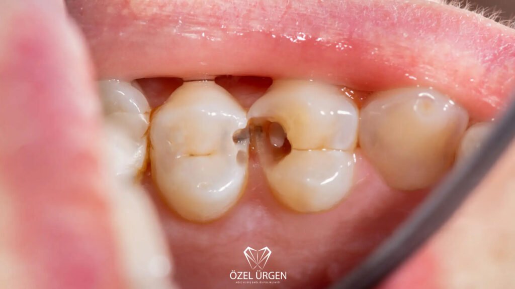 How to Relieve a Toothache Caused by Tooth Decay