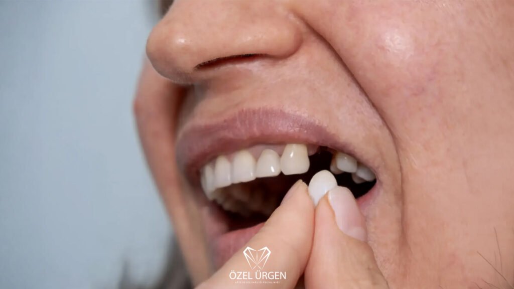 Loose Teeth in Adults
