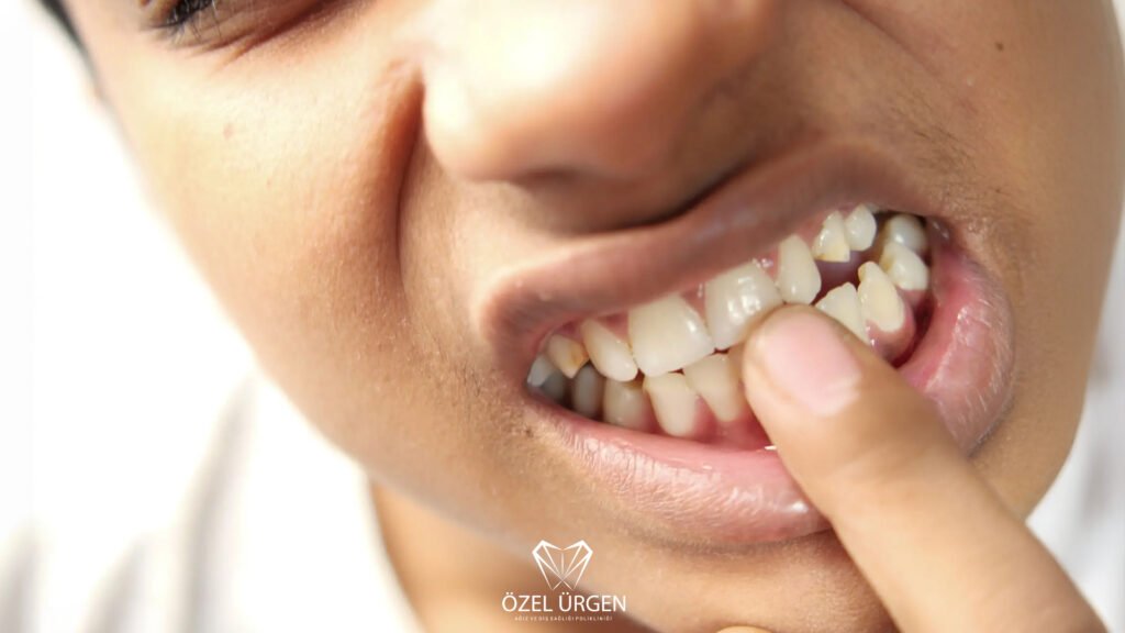 Loose Teeth in Adults
