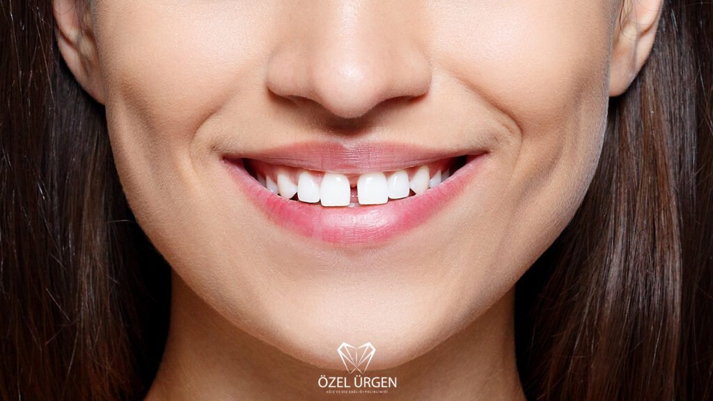 Diastema Nedir