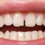 diastema 2 90x90