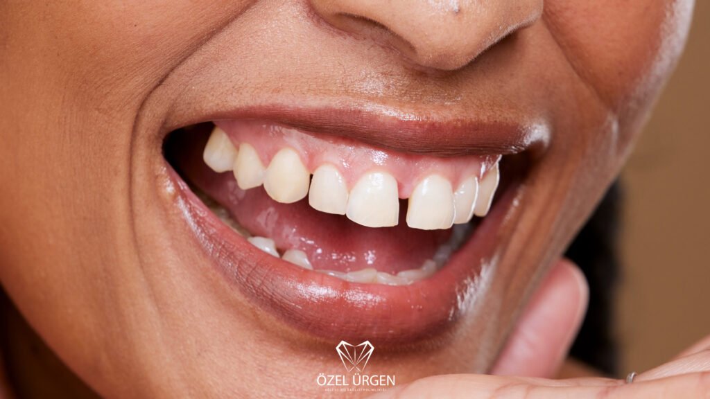 What Is Diastema