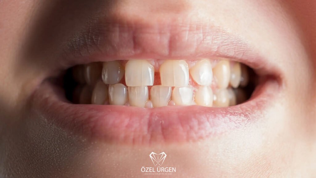 What Is Diastema