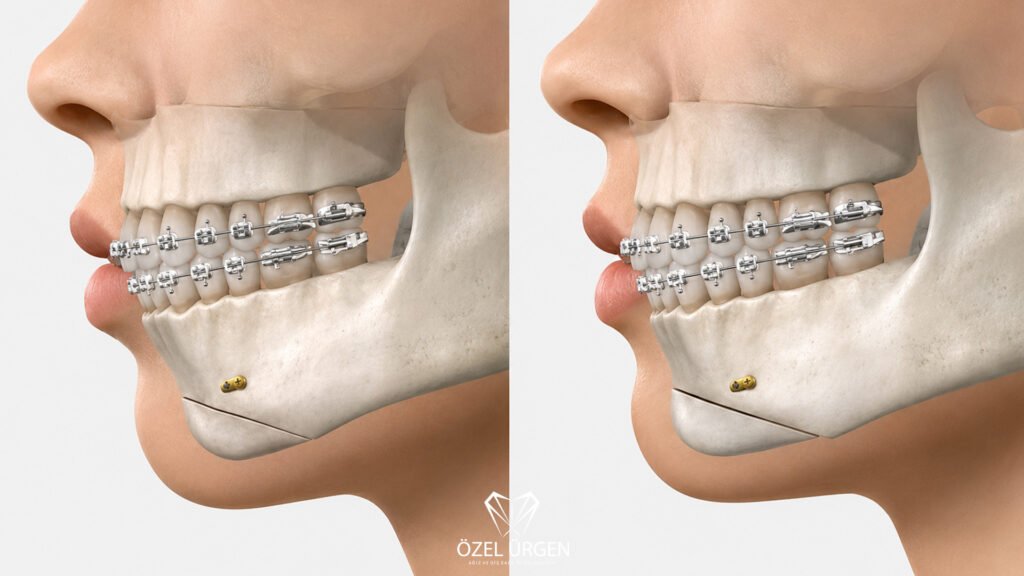 Ortognatik Cerrahi Nedir