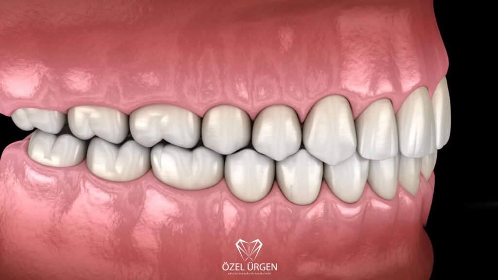 What Is Orthognathic Surgery