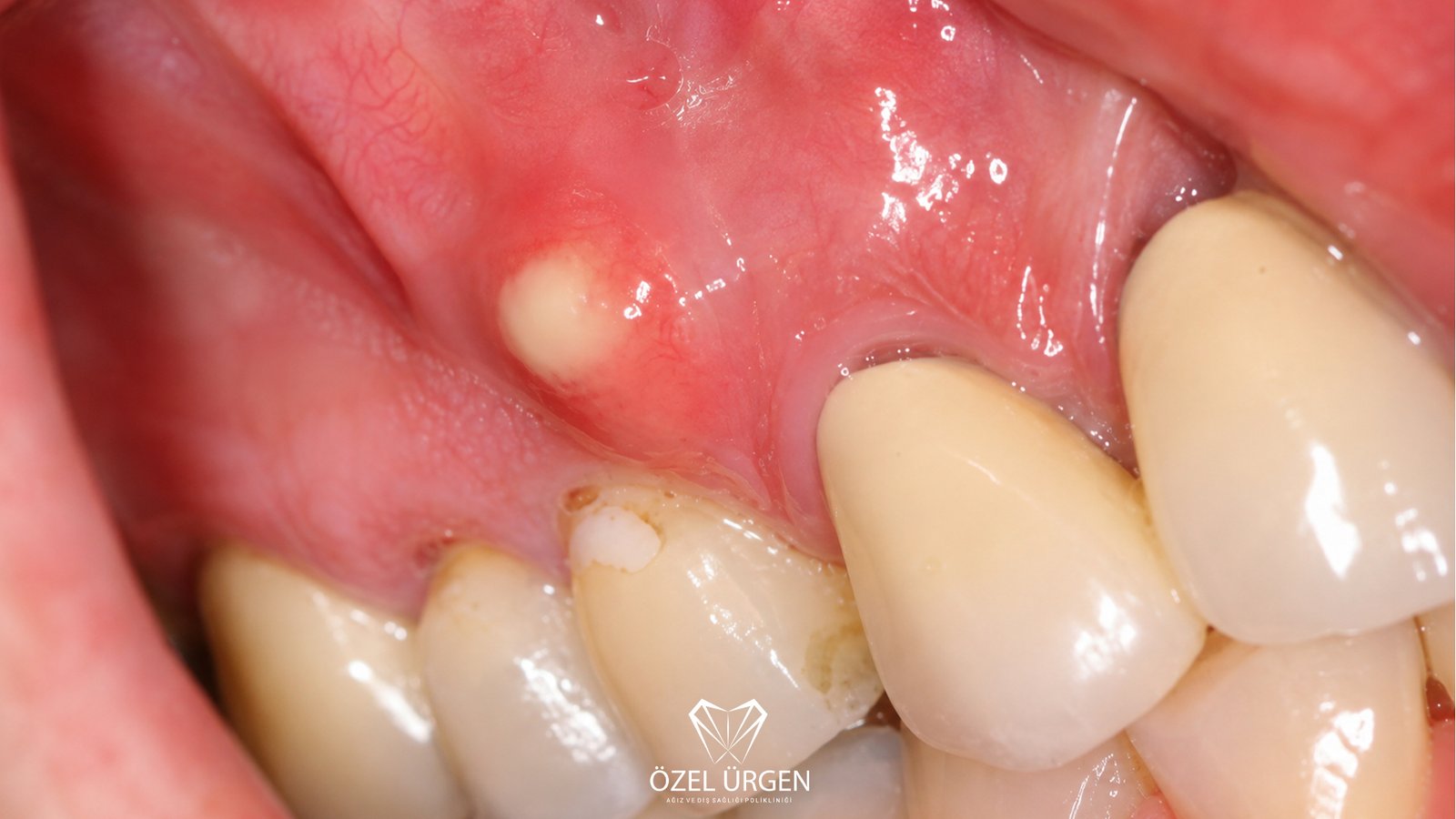 What is a Dental Abscess