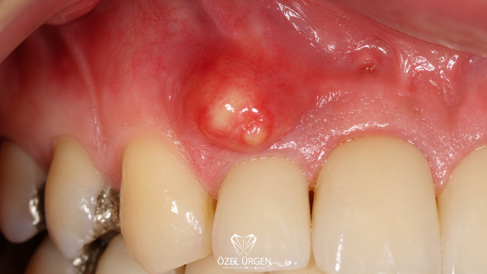 What is a Dental Abscess