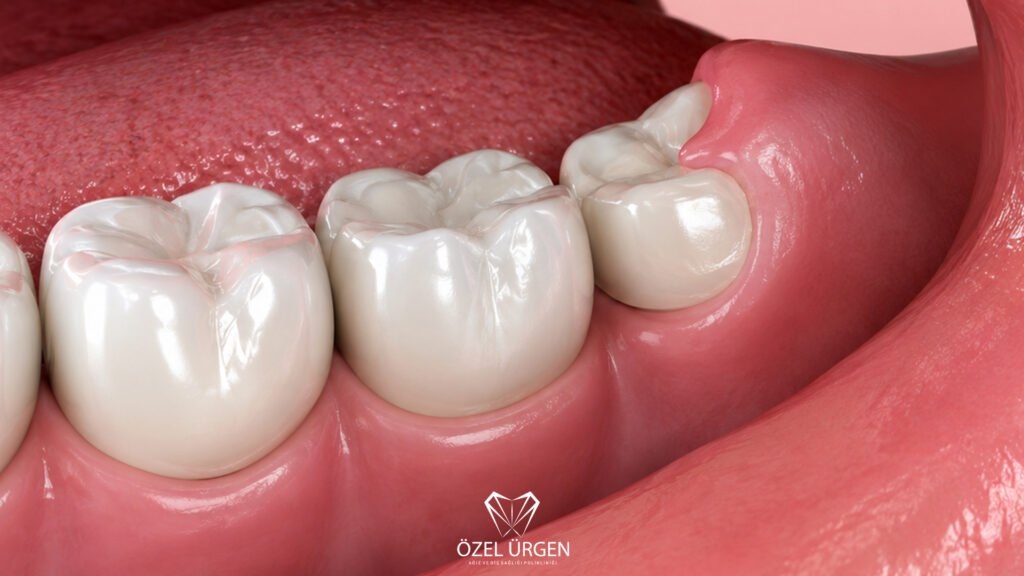 What Causes Wisdom Tooth Pain