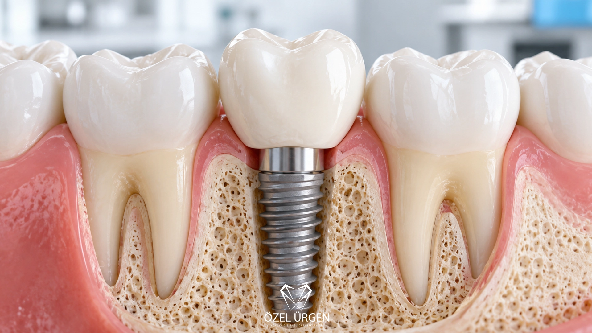 How Long Does a Dental Implant Take to Heal? 5 Stages