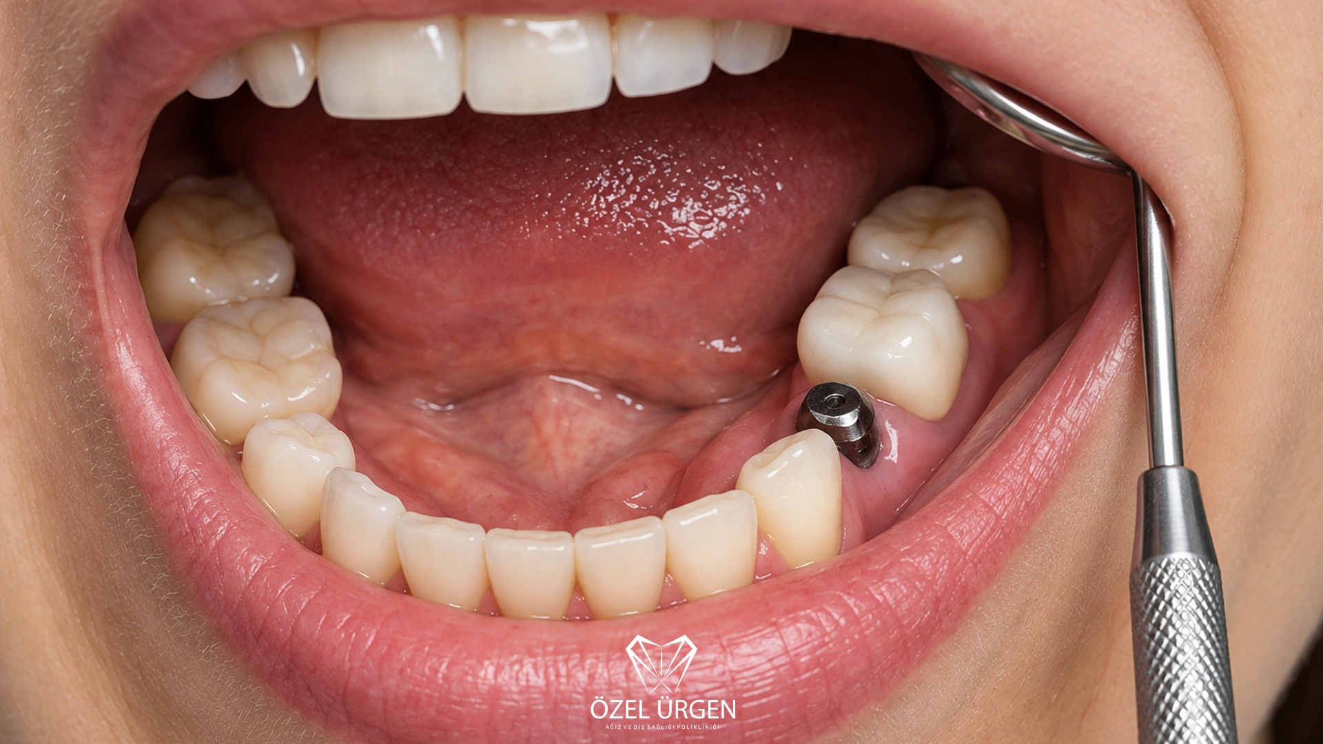 How Long Does a Dental Implant Take to Heal? 5 Stages