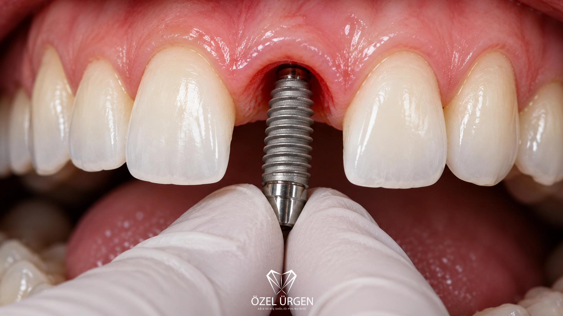 Things to consider after implant surgery