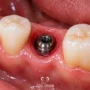 implant sonrasi nelere dikkat edilmeli 3 90x90