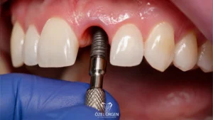 How Is Implant Treatment Performed? The 8-Stage Treatment Process