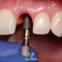 implant tedavisi nasil yapilir 2 1 90x90