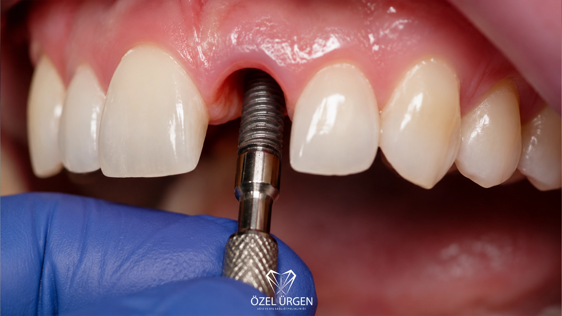 How Is Implant Treatment Performed? The 8-Stage Treatment Process