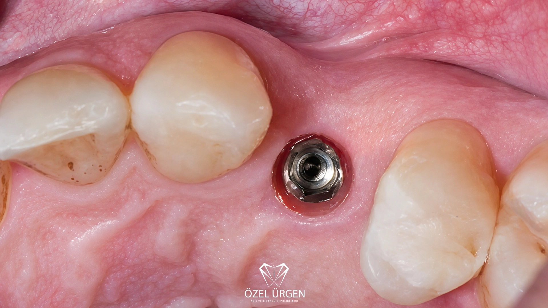 Protez diş yerleştirilmeden önce diş eti seviyesinde görünen dental implant